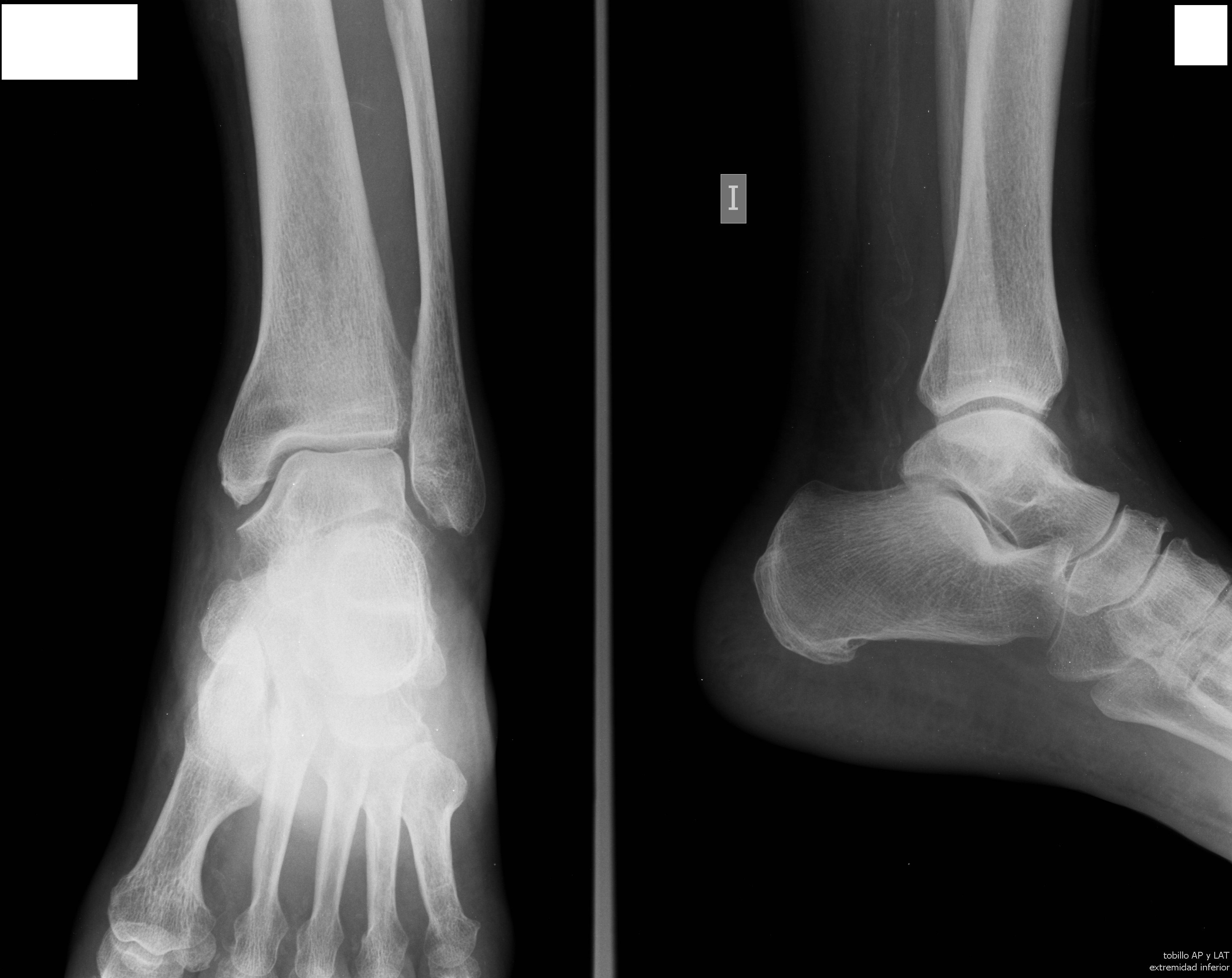 Posicionamiento AP Tobillo